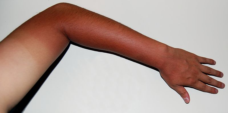 Humans evolved to be able to tan in response to excess sunlight.