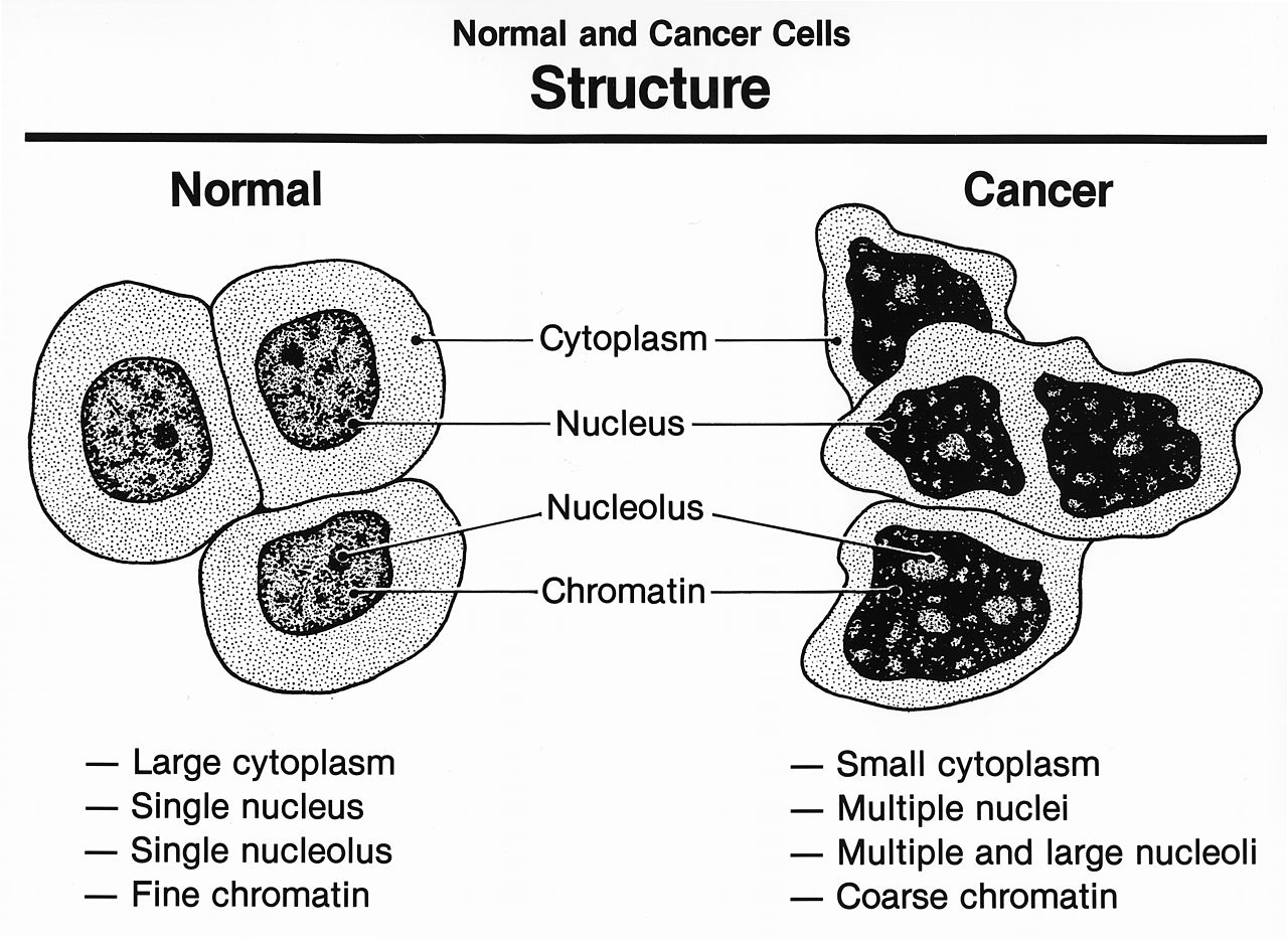 Normal cells have a large cytoplasm, a single nucleus, a single nucleolus, and fine chromatin. Next to it is shown a cancer cell with small cytoplasm, multiple nuclei, multiple and large nucleoli, and coarse chromatin.