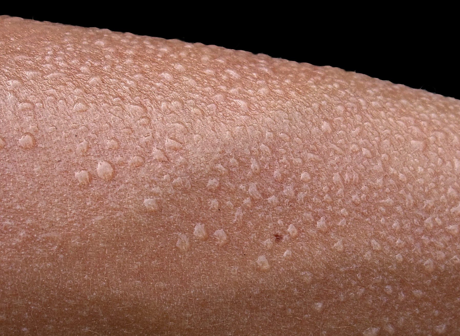 Image of a human arm with beads of sweat forming